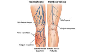 Tromboflebite e trombose: qual a diferença e os riscos?