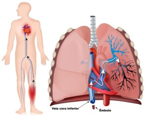 Embolia Pulmonar pode matar