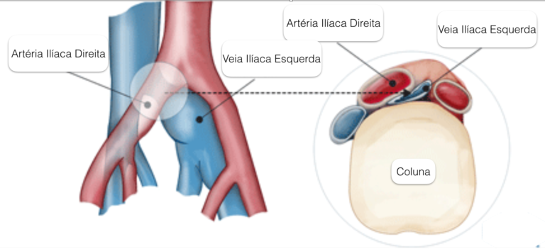 Síndromes compressivas, sabe qual a relação com a trombose?