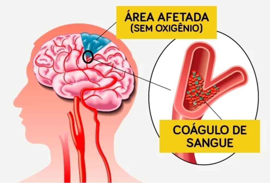 Trombose venosa cerebral: conheça os sintomas