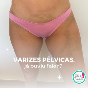 Imagem representando varizes pélvicas diagnosticadas em Thalita Mara. As varizes, dilatações anormais das veias na região pélvica.