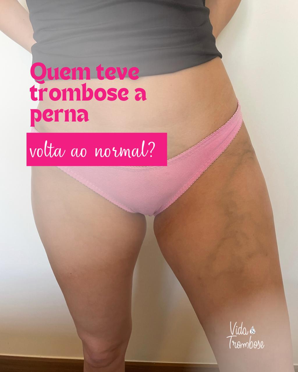 Quem teve trombose a perna volta ao normal?